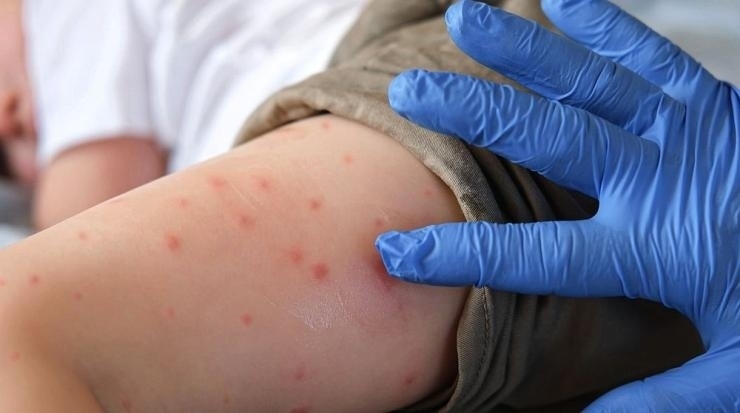 Риск от епидемия: Само за седмица новите случаи на морбили са 30