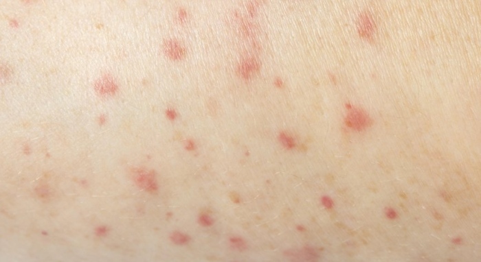 28 нови случая на морбили в област Враца за седмица